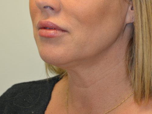 Neck Liposuction After Patient 3