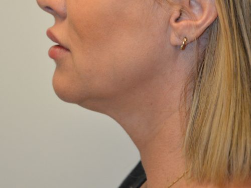 Neck Liposuction After Patient 4