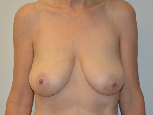 Breast Lift Before Patient 1
