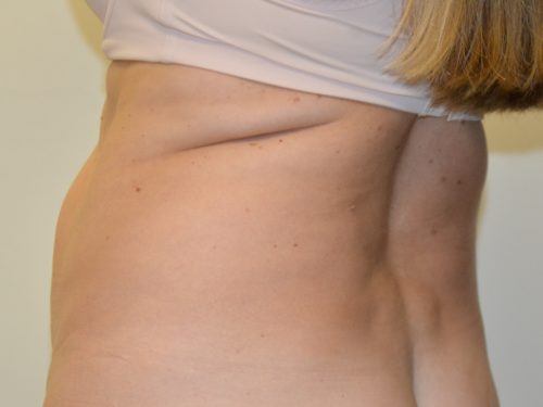 Liposuction Before Patient 2