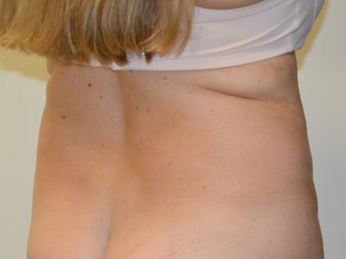 Liposuction Before Patient 3