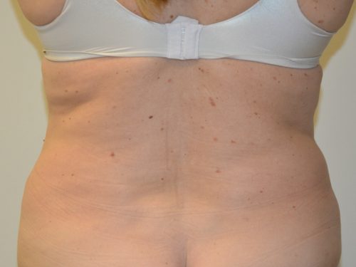 Liposuction After Patient 1