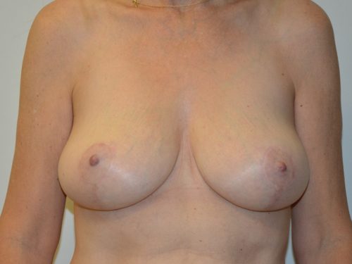 Breast Lift After Patient 1