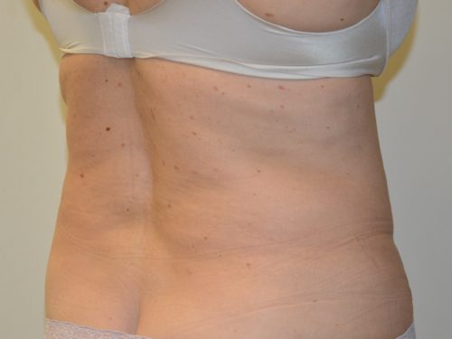 Liposuction After Patient 3