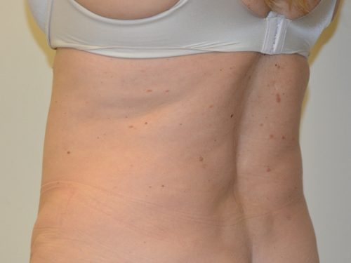 Liposuction After Patient 2