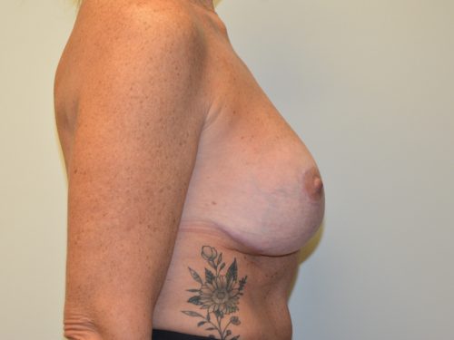 Breast Revision After Patient 4