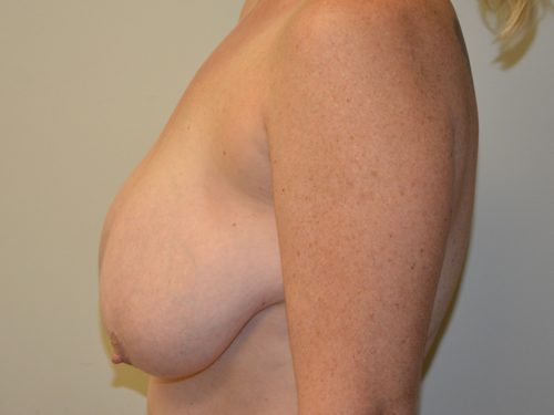 Breast Reduction Before Patient 3