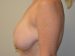Breast Reduction Before Patient Thumbnail 3