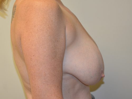 Breast Reduction Before Patient 5