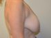 Breast Reduction Before Patient Thumbnail 5