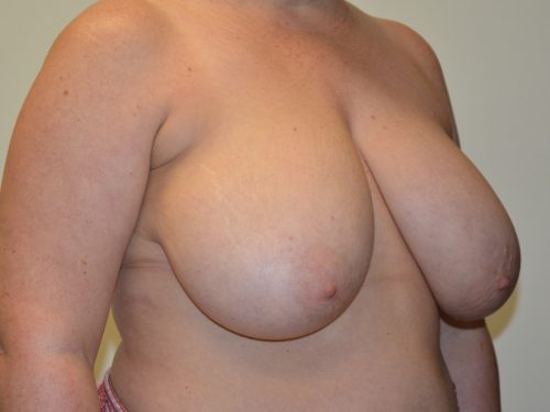 Breast Reduction Before Patient 2