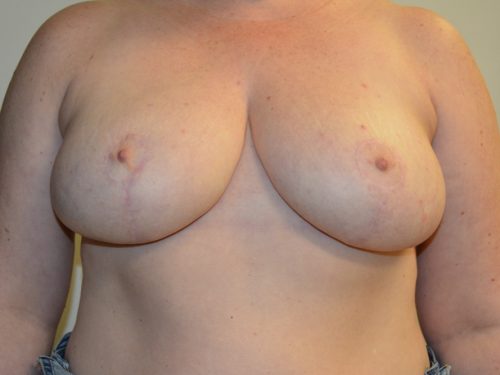 Breast Reduction After Patient 1