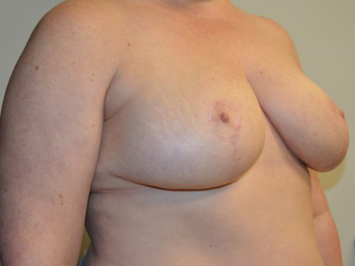 Breast Reduction After Patient 2