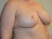 Breast Reduction After Patient Thumbnail 2