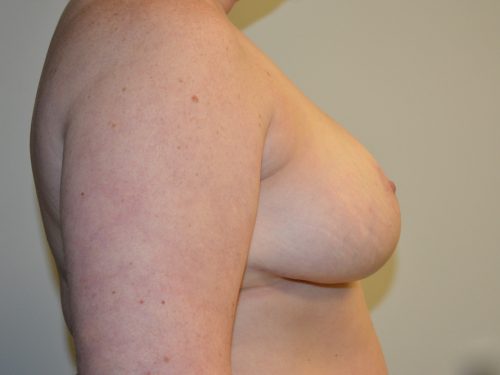 Breast Reduction After Patient 3