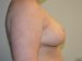 Breast Reduction After Patient Thumbnail 3