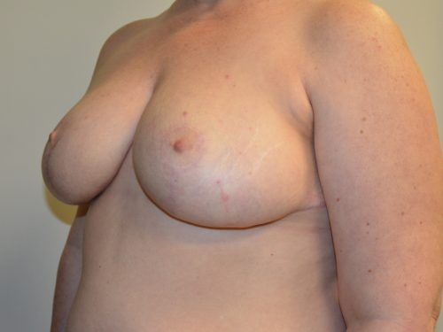 Breast Reduction After Patient 4