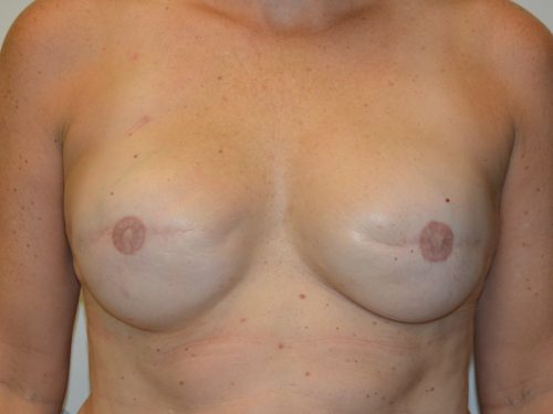 Breast Reconstruction Tissue Expanders After Patient 1