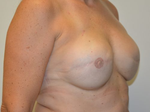 Breast Reconstruction Tissue Expanders After Patient 4