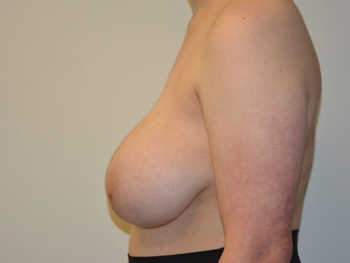 Breast Reduction Before Patient 3