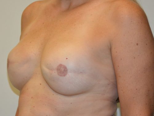 Breast Reconstruction Tissue Expanders After Patient 2