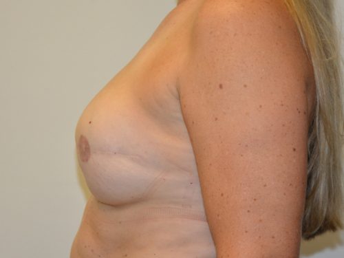 Breast Reconstruction Tissue Expanders After Patient 3