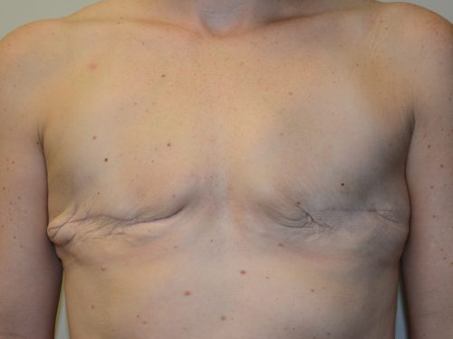 Breast Reconstruction Tissue Expanders Before Patient 1