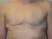 Breast Reconstruction Tissue Expanders Before Patient Thumbnail 1