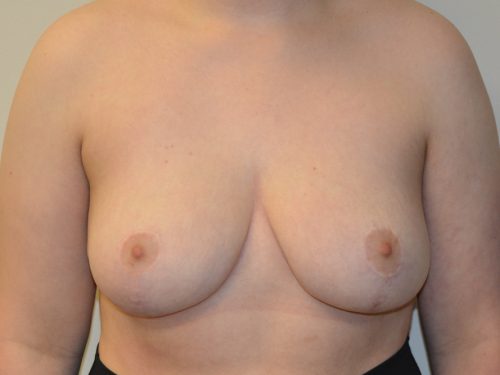 Breast Reduction After Patient 1