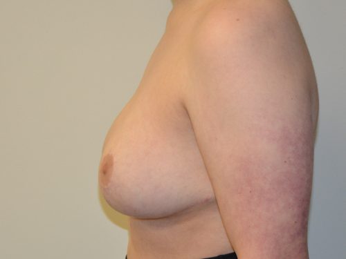 Breast Reduction After Patient 3