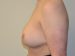 Breast Reduction After Patient Thumbnail 3