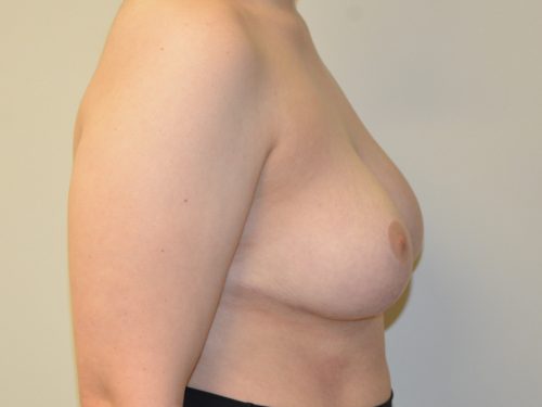 Breast Reduction After Patient 5