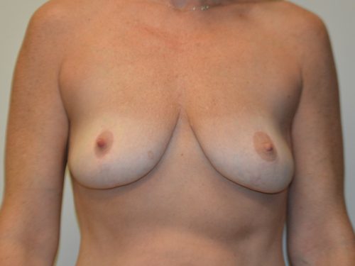 Breast Augmentation Before Patient 1