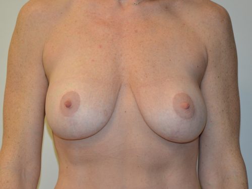 Breast Augmentation After Patient 1