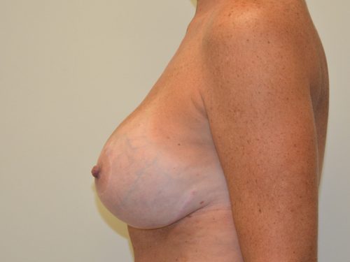 Breast Revision Before Patient 1