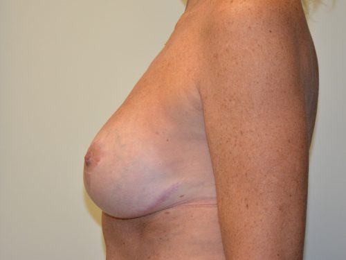Breast Revision After Patient 1
