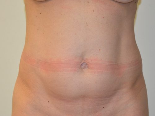 Tummy Tuck Before Patient 1