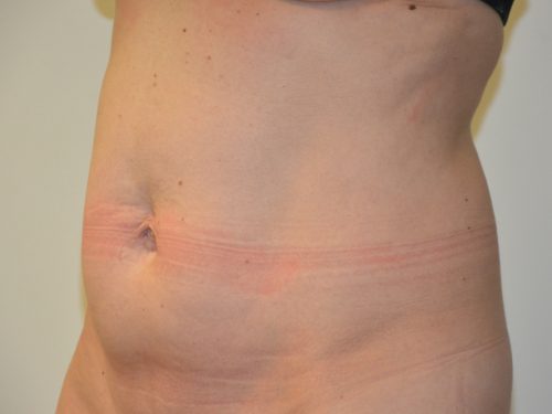 Tummy Tuck Before Patient 2