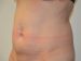 Tummy Tuck Before Patient Thumbnail 2