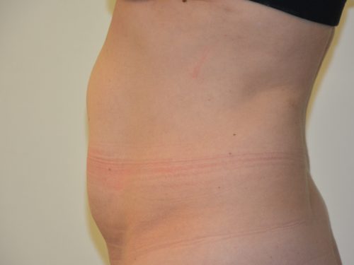 Tummy Tuck Before Patient 3