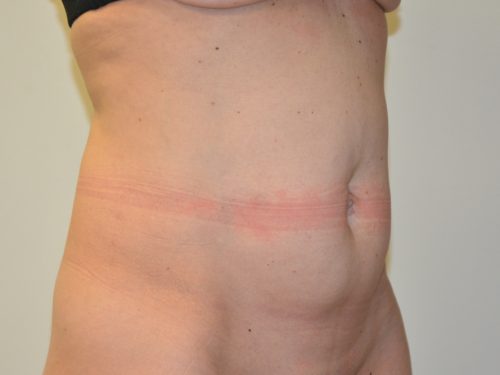 Tummy Tuck Before Patient 4