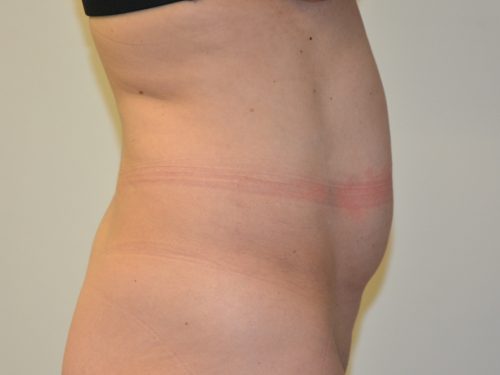 Tummy Tuck Before Patient 5