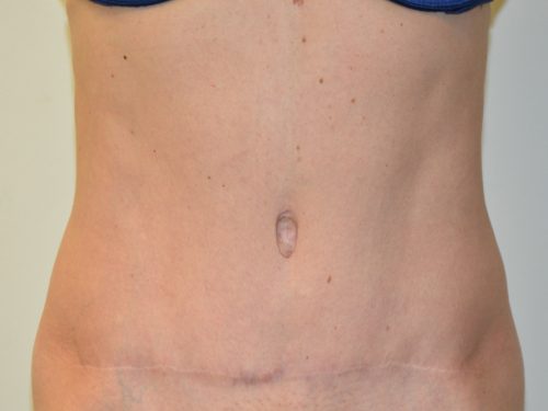 Tummy Tuck After Patient 1