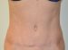 Tummy Tuck After Patient Thumbnail 1