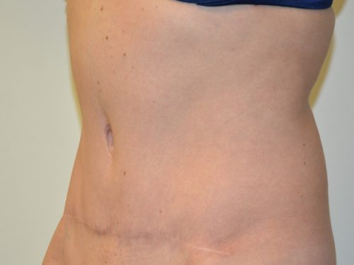 Tummy Tuck After Patient 2