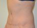 Tummy Tuck After Patient Thumbnail 2