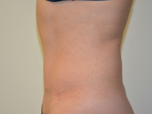 Tummy Tuck After Patient 3