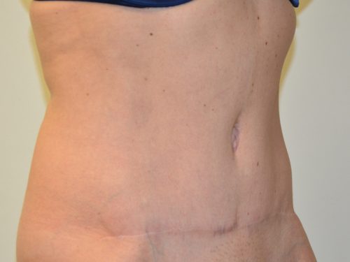 Tummy Tuck After Patient 4