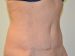 Tummy Tuck After Patient Thumbnail 4