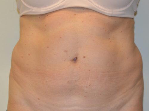 Tummy Tuck Before Patient 1